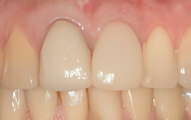 IMPLANTOLOGIE : CAS COMBINÉS COMPLEXES