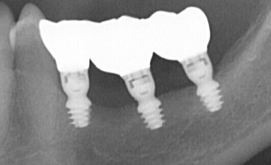 Les implants courts