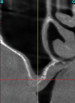 GREFFE DU SINUS: QUELLE GREFFE ?