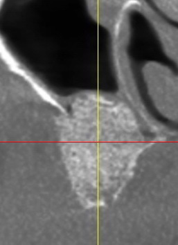 GREFFE DU SINUS: LE COMBLEMENT SINUSIEN