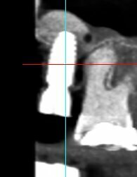 GREFFE DU SINUS: LE SOULEVEMENT SINUSIEN
