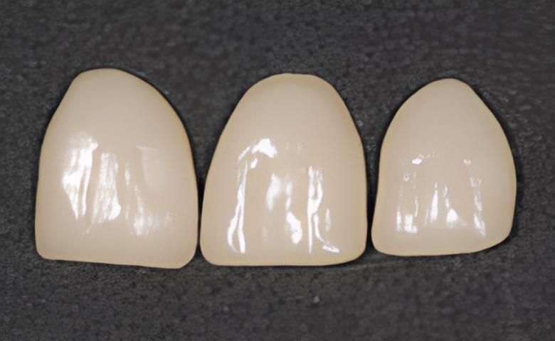 DENTISTERIE ESTHÉTIQUE : LES FACETTES
