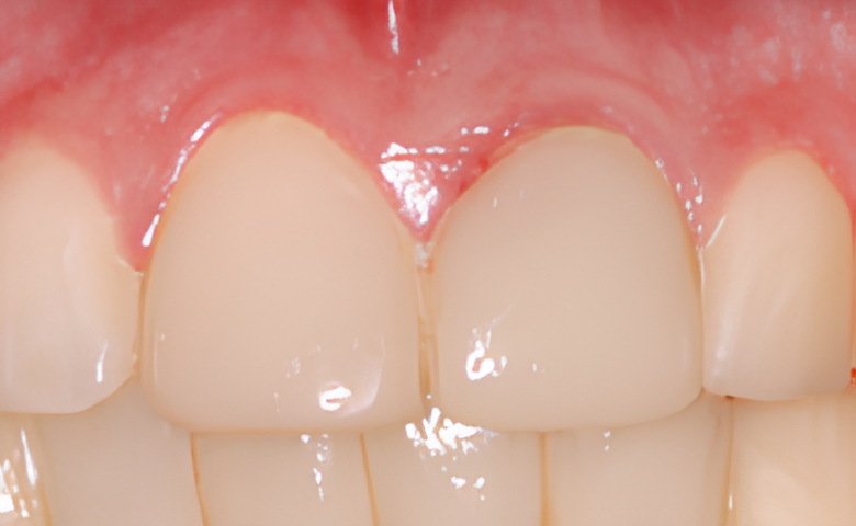 DENTISTERIE ESTHÉTIQUE : LES COURONNES