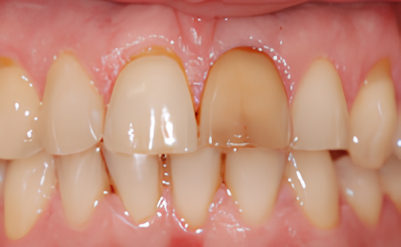 DENTISTERIE ESTHÉTIQUE : FÊLURES ET FRACTURES DENTAIRES : CE QU'IL FAUT SAVOIR