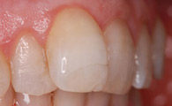 DENTISTERIE ESTHÉTIQUE : FÊLURE ET FRACTURE DENTAIRE : STADE 1