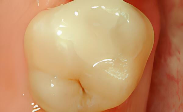 DENTISTERIE ESTHÉTIQUE : LES INLAYS ET LES INCRUSTATIONS