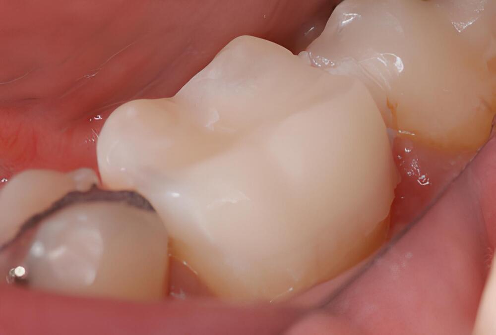 DENTISTERIE ESTHÉTIQUE : LES ONLAYS