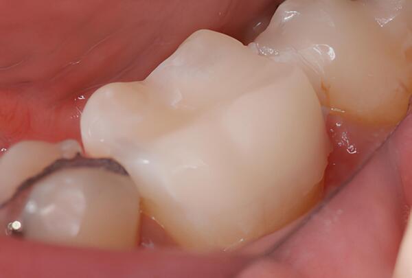 DENTISTERIE ESTHÉTIQUE : LES ONLAYS