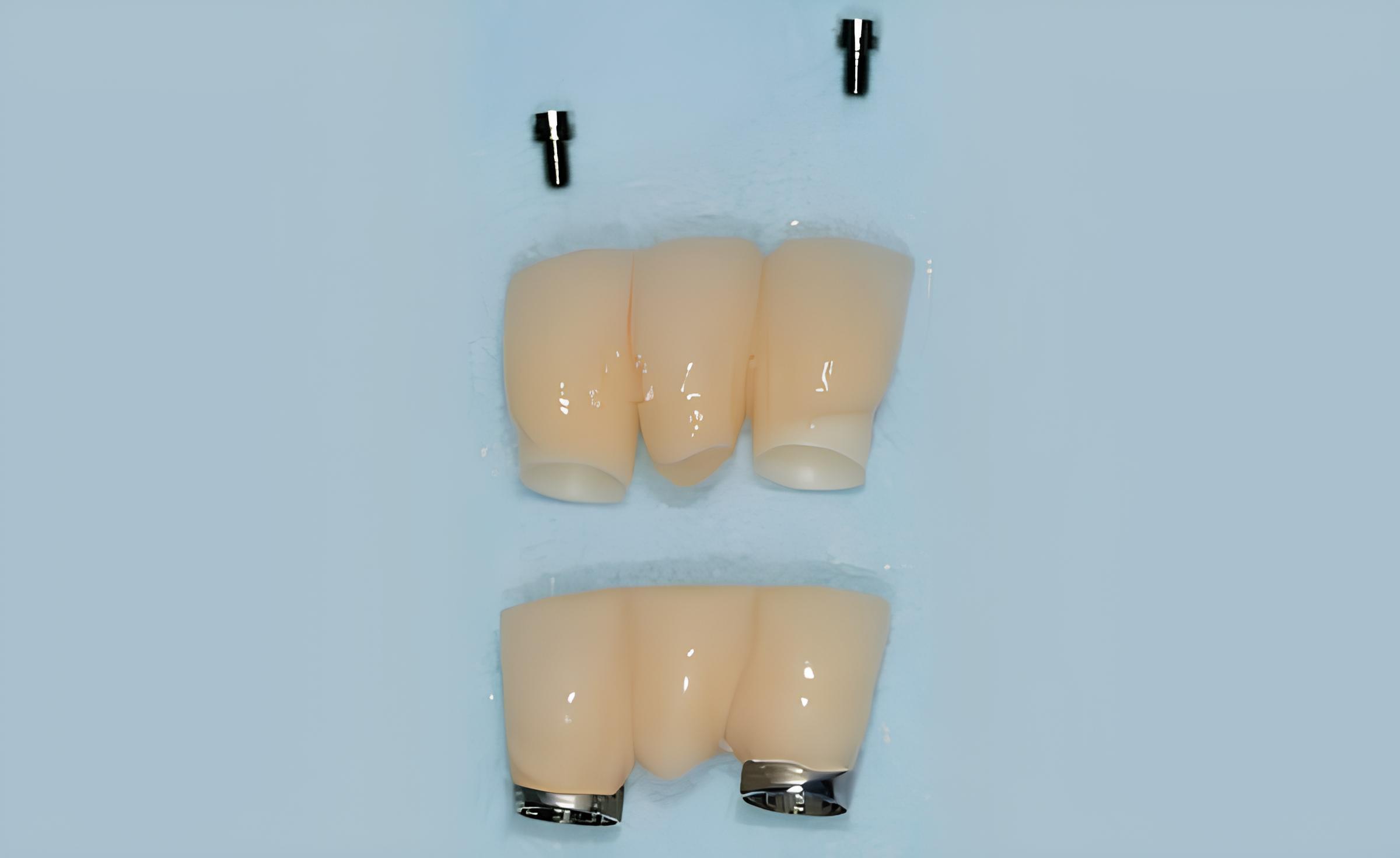 IMPLANTATION: QUE FAIRE PENDANT L'OSTÉOINTÉGRATION ?