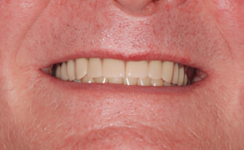 IMPLANTOLOGIE: LES PROTHÈSES AMOVIBLES STABILISÉES SUR DES BOUTONS-PRESSION