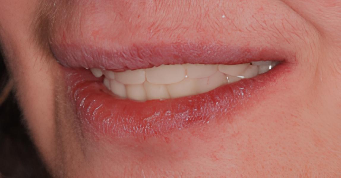 IMPLANTOLOGIE : LES BRIDGES FIXES COMPLETS MANDIBULAIRES