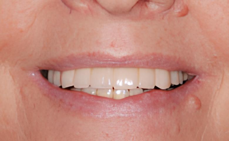 IMPLANTOLOGIE: LES BRIDGES FIXES COMPLETS AU MAXILLAIRE