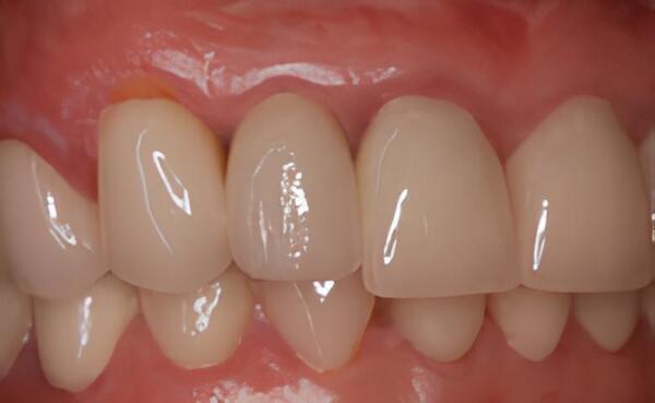 IMPLANTOLOGIE: LES IMPLANTS DANS LE SECTEUR ESTHÉTIQUE