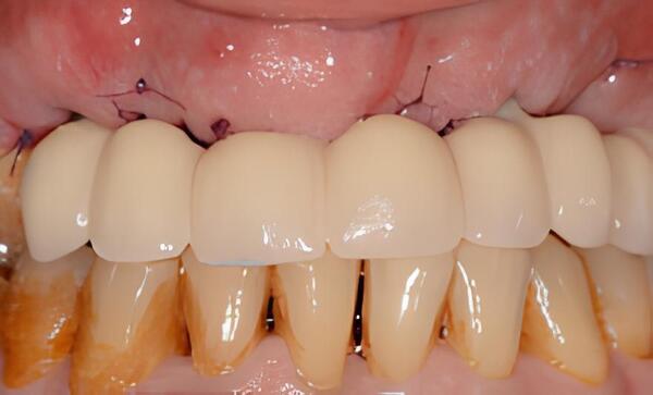 IMPLANTOLOGIE : LES BRIDGES FIXES PARTIELS