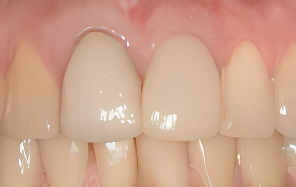 IMPLANTOLOGIE: L'ÉLARGISSEMENT DE CRÊTE OSSEUSE : LA RÉGÉNÉRATION OSSEUSE GUIDÉE (R.O.G.)