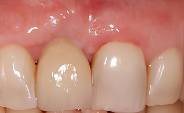 IMPLANTOLOGIE: GREFFE CONJONCTIVE ENFOUIE LORS D’UNE IMPLANTATION