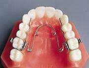 Le quad helix : traitement du palais et de l’alignement des dents