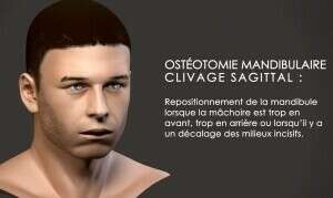 Ostéotomie mandibulaire