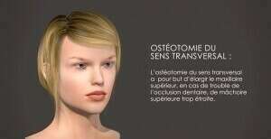 Ostéotomie d'expansion maxillaire