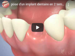 pose d'un implant dentaire en 2 temps avec un pilier titane