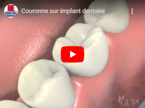 Couronne sur implant dentaire