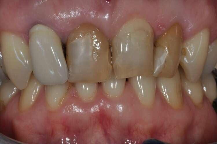 Avant réhabilitation du sourire