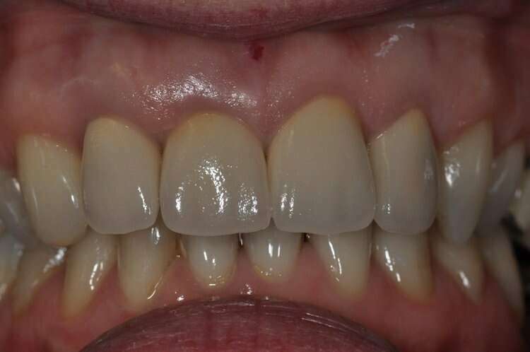 Après réhabilitation du sourire