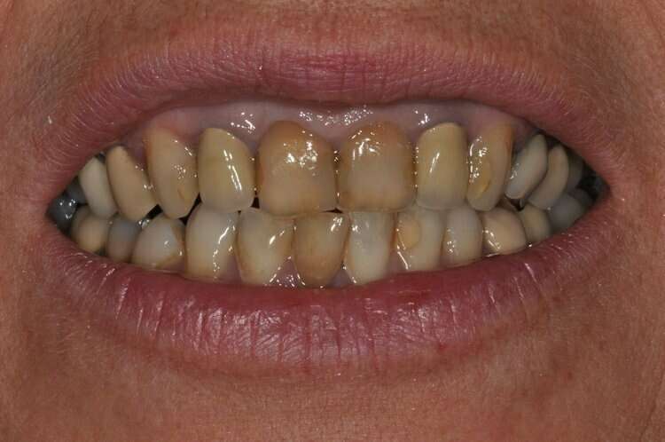 Avant Réhabilitation du sourire