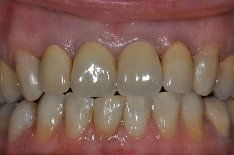 Après Réhabilitation du sourire