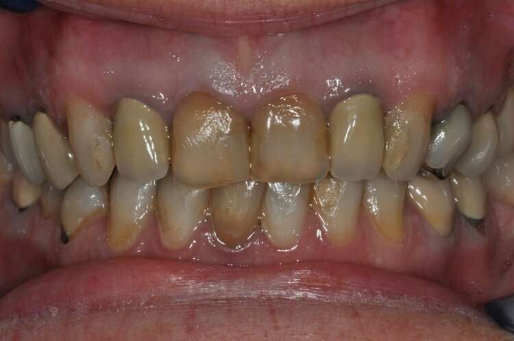 Avant Réhabilitation du sourire