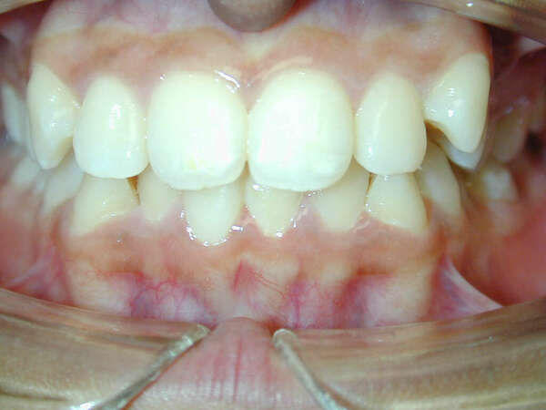 Orthodontie Linguale Bordeaux