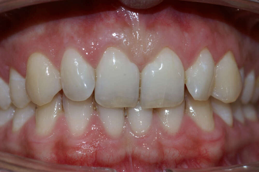 orthodontie linguale à Bordeaux
