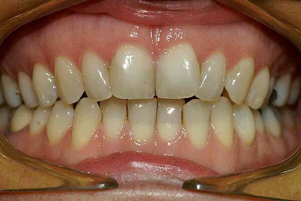 Cas de Damon avec attaches transparentes