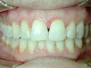 Cas pratique par gouttières transparentes n°1