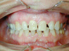 Cas pratique par gouttières transparentes n°2