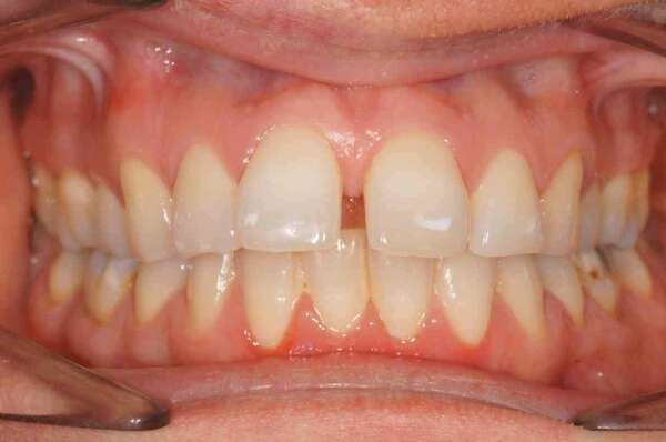 Cas pratique par gouttières transparentes n°3