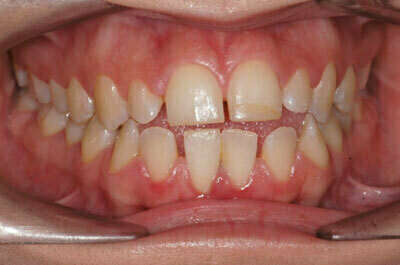 Béance traitée par gouttières