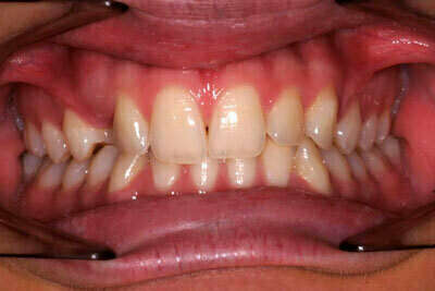 Canine incluse traitée avec des gouttières