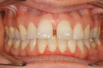 Décalage traité par gouttières