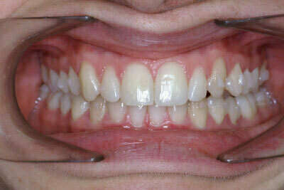 Traitement par gouttières et chirurgie