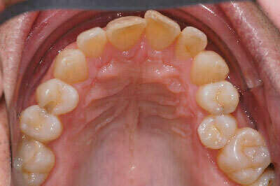 Trompettiste traité par gouttières