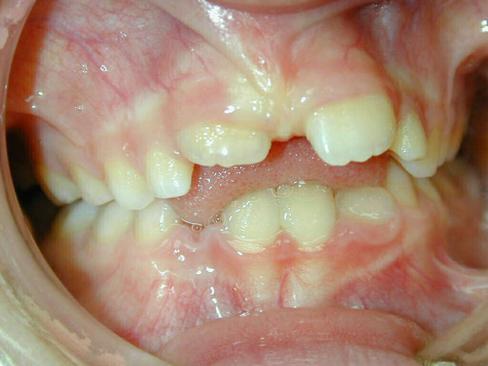 Traitement d'orthodontie fonctionelle Bordeaux