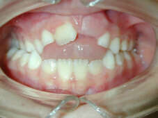 Traitement d'interception d'un jeune enfant de 7 ans