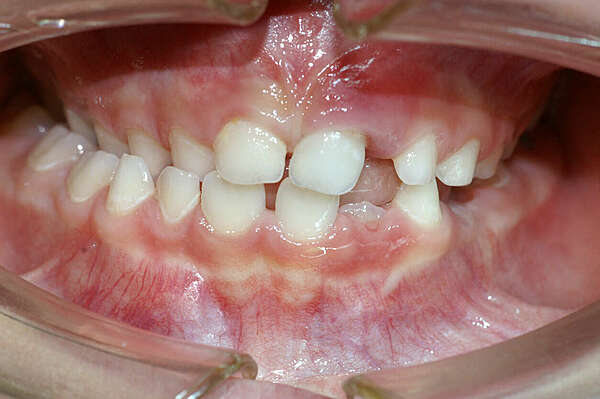 Correction d'un décalage de la mâchoire chez un jeune enfant.