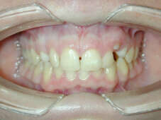 Cas de traitement d'une adolescente