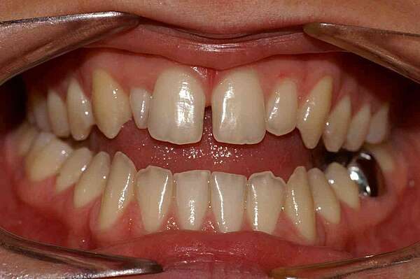 Béance chirurgicale - cas traité au cabinet d'Orthodontie à Bordeaux 33000