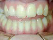 Béance traitée sans chirurgie par plaques d'ingression