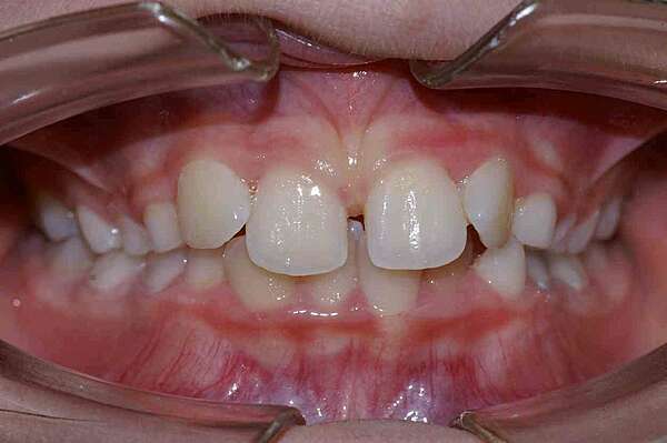 Morphing d'un Traitement d'Interception - Cabinet d'orthodontie à Bordeaux