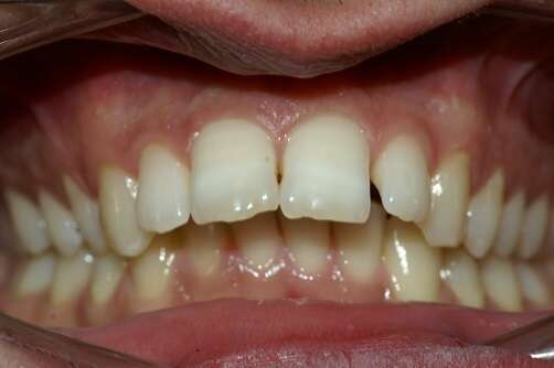 Rétrognathie mandibulaire traitée par orthodontie chirurgicalement en technique linguale