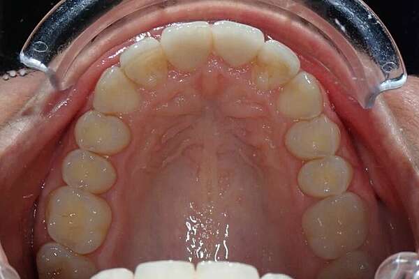 Correction d' un décage  squelettique traité par gouttieres et chirurgie